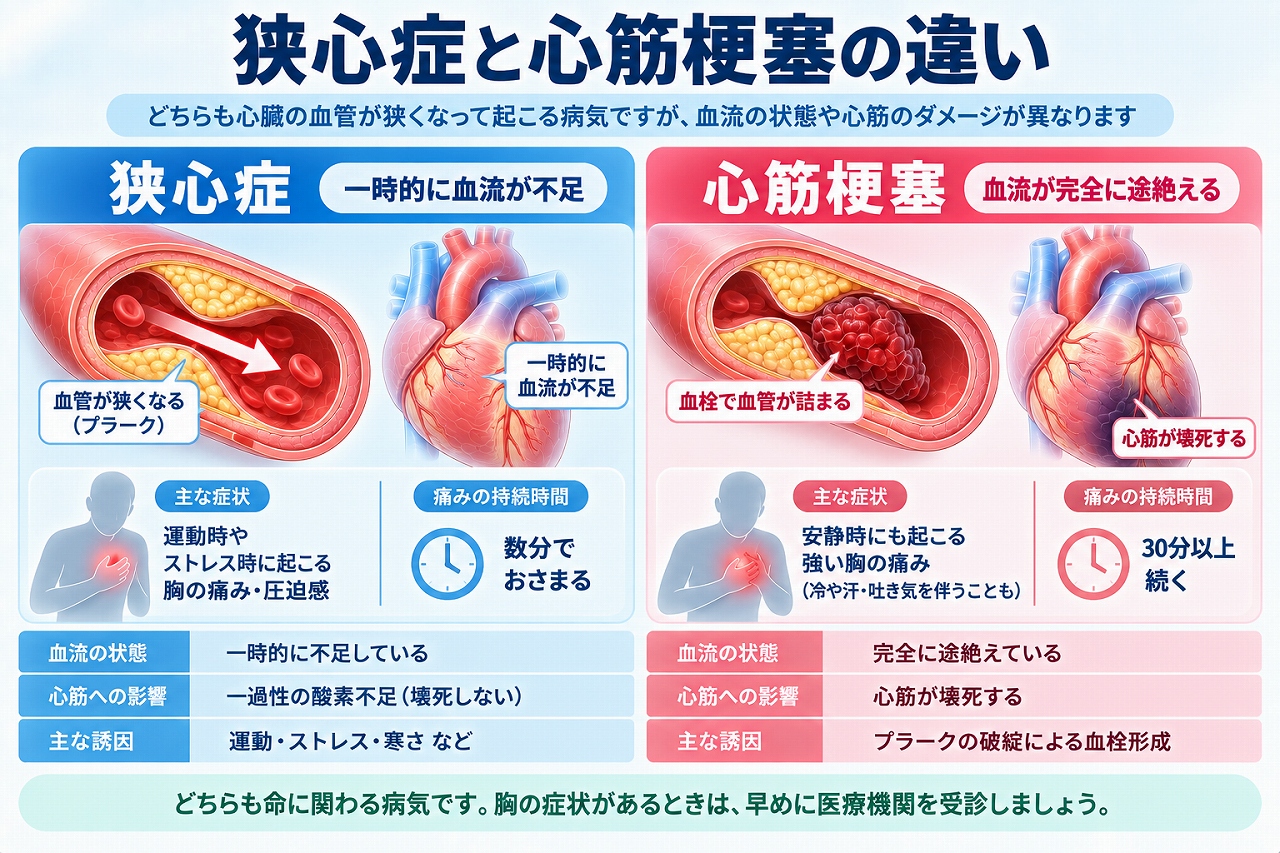 狭心症と心筋梗塞の違いを、冠動脈の血流低下と血栓による閉塞、胸痛の特徴、心筋への影響などから比較して示した図