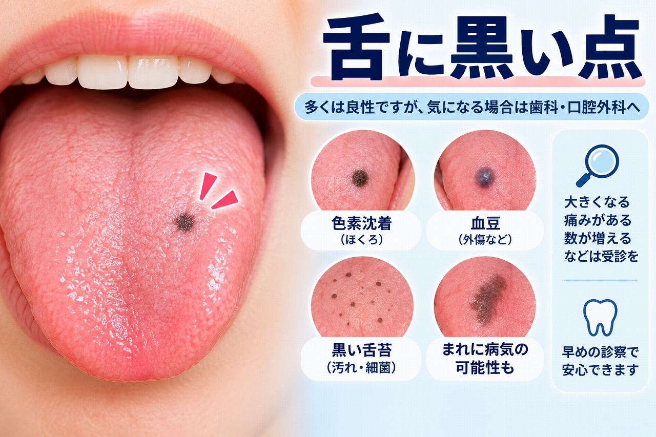舌に黒い点ができた状態と、色素沈着・血豆・黒い舌苔など考えられる原因を示したイラスト