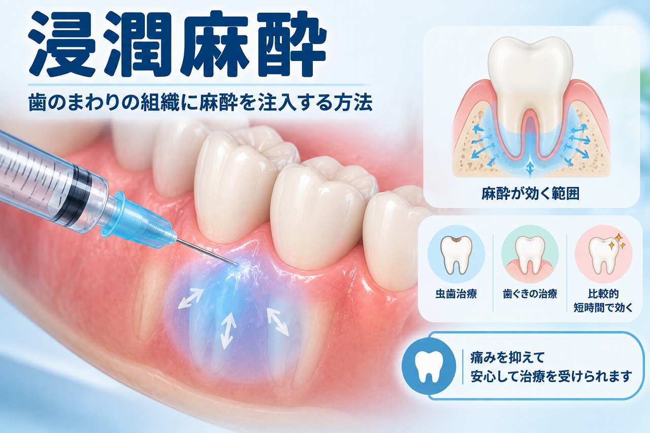 浸潤麻酔で歯ぐきに麻酔薬を注入し、歯の周囲の組織へ麻酔を浸透させて痛みを抑える仕組みを示した歯科イラスト