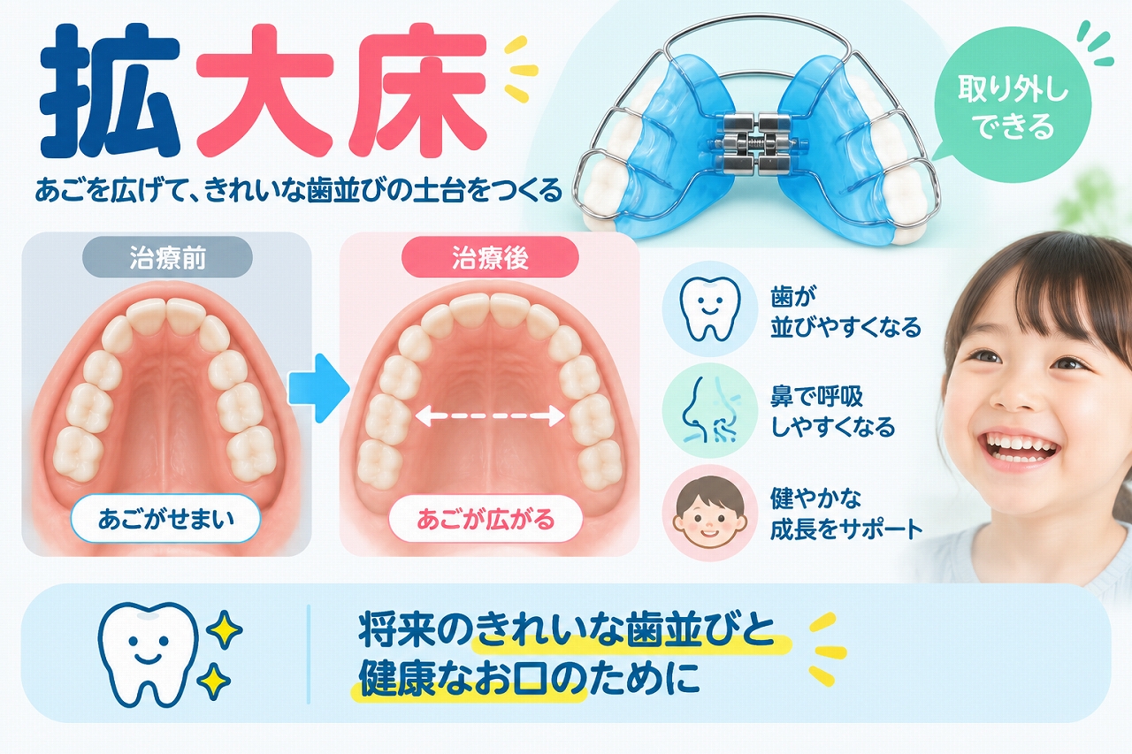 拡大床を使って子どもの歯列を横方向に広げ、永久歯が並ぶためのスペースを確保する治療前後を示した歯科イラスト