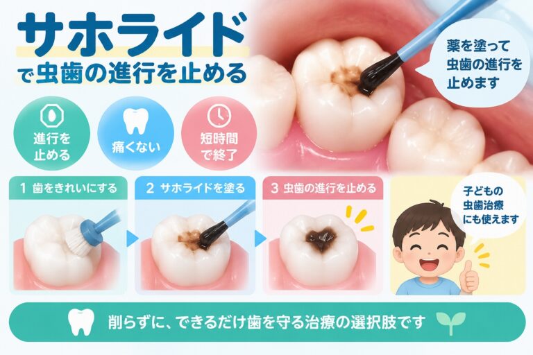 サホライドを虫歯部分に塗布して、乳歯などの虫歯の進行を抑える治療方法を示した歯科イラスト