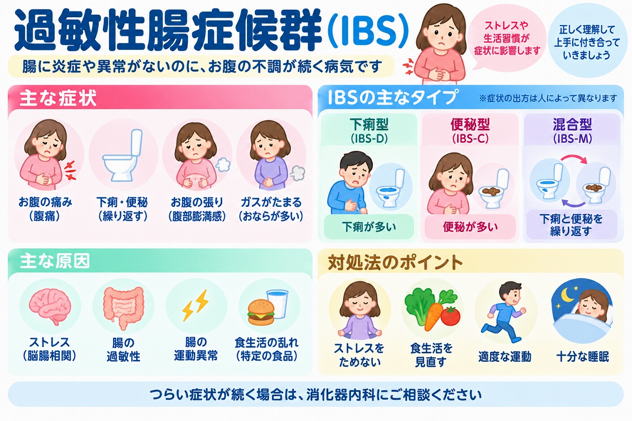 過敏性腸症候群（IBS）の症状や種類、原因、対処法を解説した医療インフォグラフィック。腹痛、下痢、便秘、お腹の張りなどの症状と、下痢型・便秘型・混合型の3タイプを比較。ストレス、脳腸相関、腸の知覚過敏、食生活との関係や、生活習慣の改善、運動、睡眠などの対処法を図解。