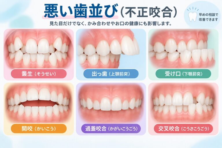 悪い歯並び（不正咬合）の種類｜叢生・出っ歯・受け口・開咬など
