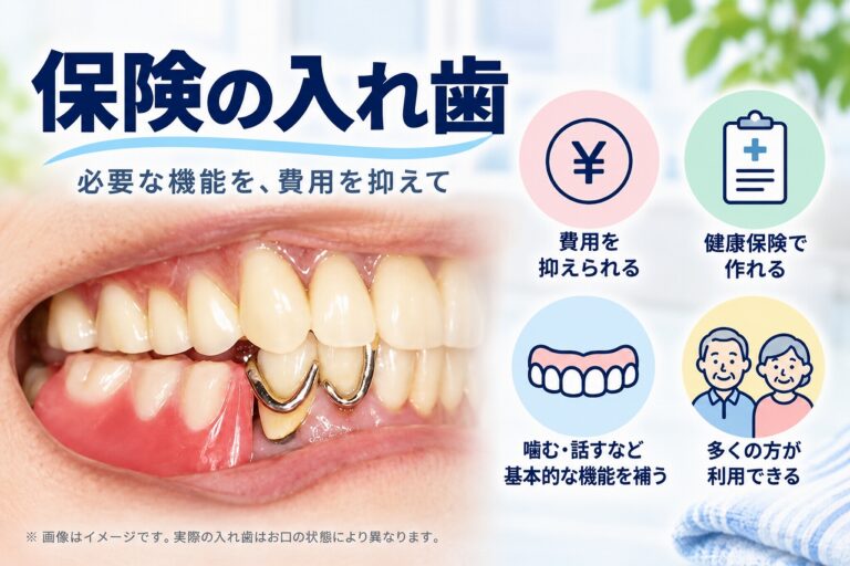 保険適用の部分入れ歯について、金属のクラスプで入れ歯を固定する様子と、費用や健康保険、噛む・話す機能を補う特徴を示したイメージ