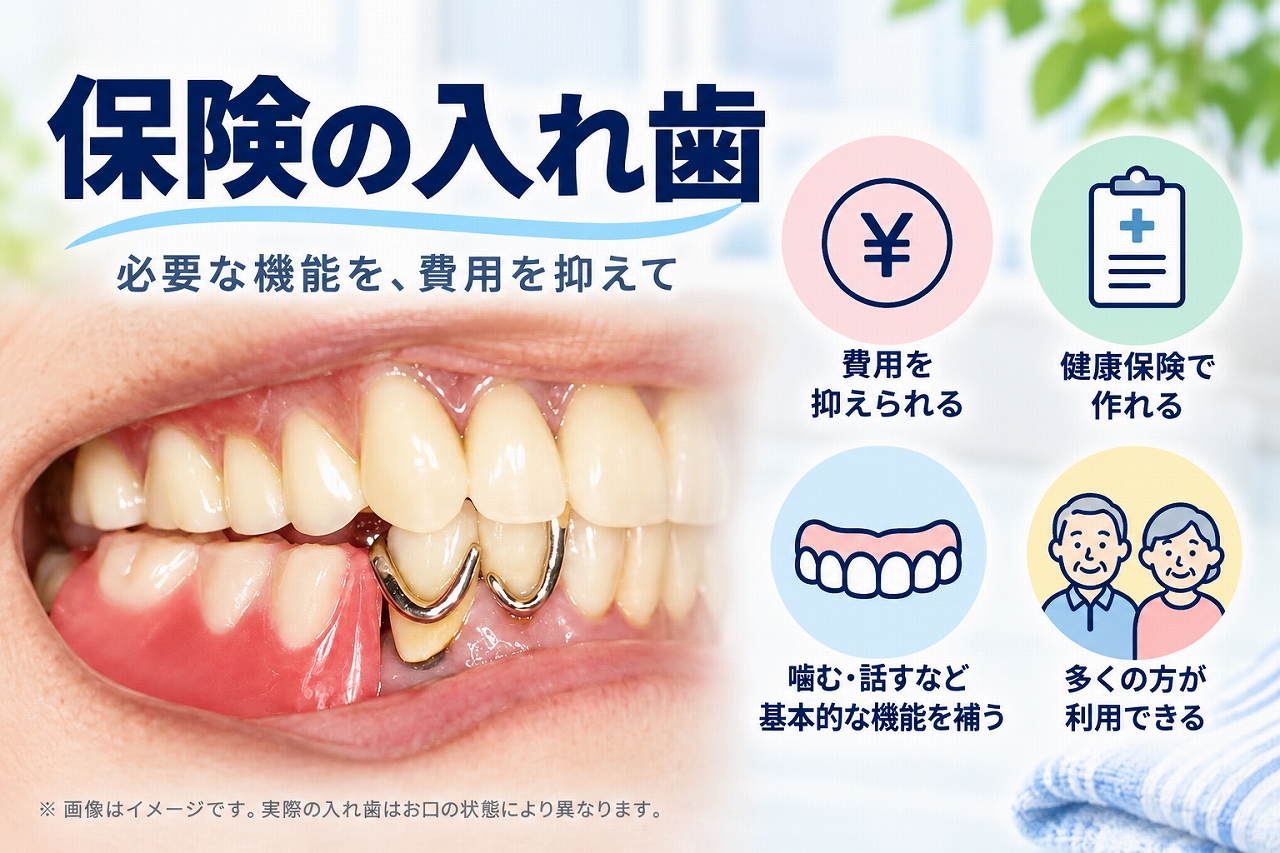 保険適用の部分入れ歯について、金属のクラスプで入れ歯を固定する様子と、費用や健康保険、噛む・話す機能を補う特徴を示したイメージ