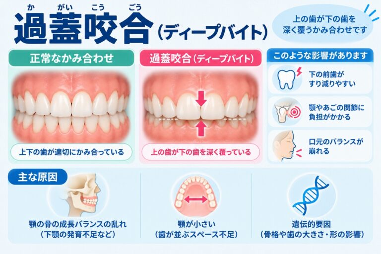 過蓋咬合（ディープバイト）について、上の前歯が下の前歯を深く覆う状態を正常なかみ合わせと比較し、主な原因や影響を示した歯科イラスト