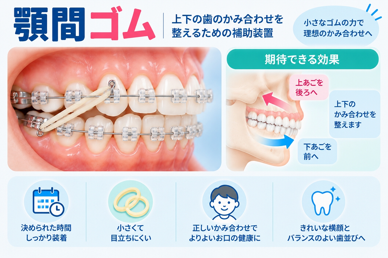 ワイヤー矯正で上下の歯に顎間ゴムを装着し、ゴムの力を利用して上下の歯の位置やかみ合わせを調整する仕組みを示した歯科イラスト