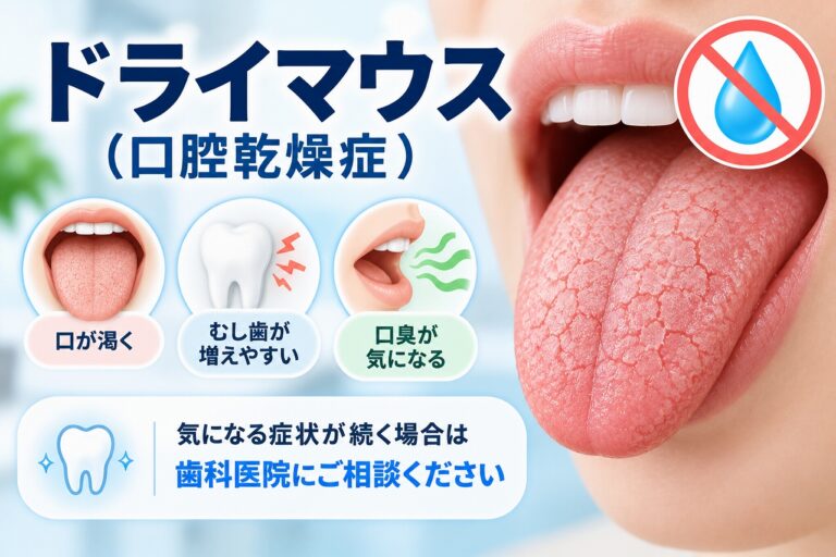 ドライマウス（口腔乾燥症）による口の渇きと、むし歯や口臭のリスクを示したイラスト