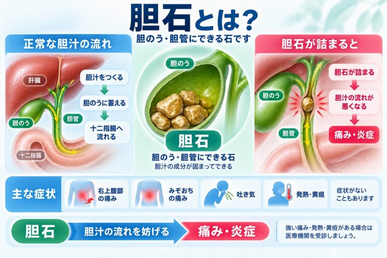 胆石とは？胆のう・胆管に石ができる仕組みと症状