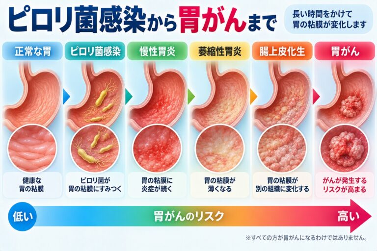 ピロリ菌感染から慢性胃炎、萎縮性胃炎、腸上皮化生を経て胃がんリスクが高まるまでの胃粘膜の変化を段階的に示した図