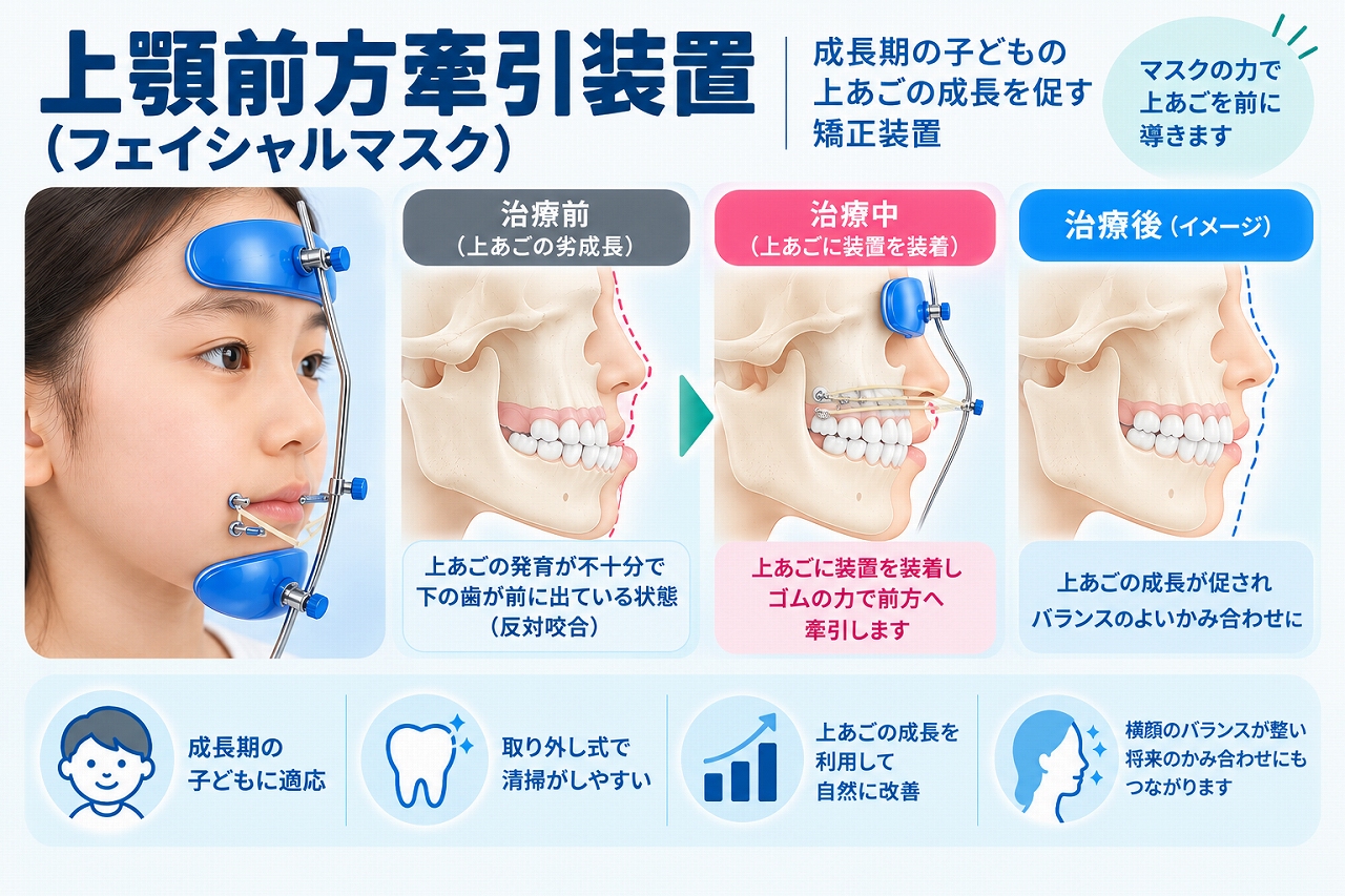 上顎前方牽引装置（フェイシャルマスク）を使用し、成長期の上顎を前方へ牽引して上顎の劣成長による反対咬合の改善を図る仕組みを示した小児矯正のイラスト