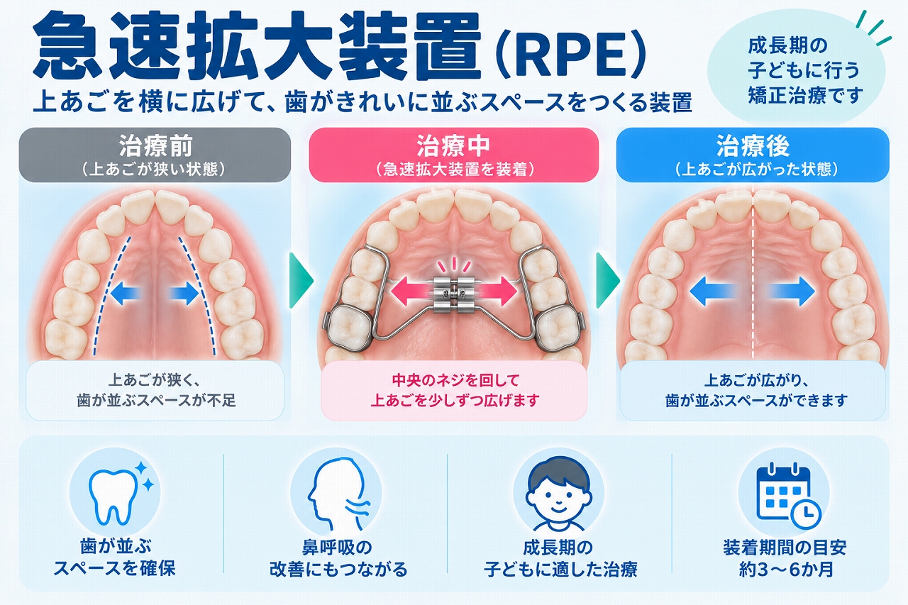 急速拡大装置（RPE）を上顎に装着し、中央の拡大ネジを利用して上顎を左右に広げ、歯が並ぶスペースを確保する仕組みを示した歯科イラスト