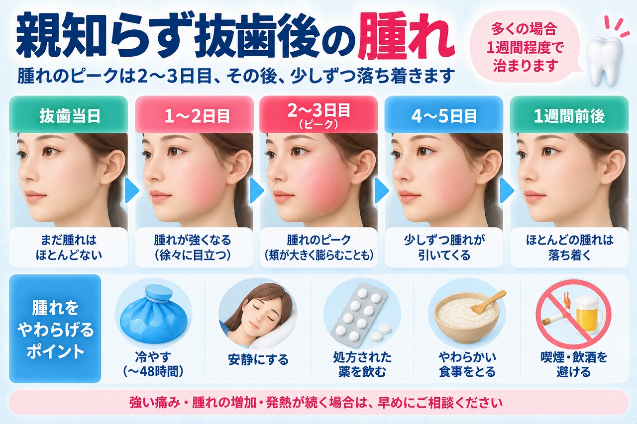 親知らず抜歯後の腫れについて、抜歯当日から2〜3日目のピーク、4〜5日目、1週間前後までの腫れの経過と対処法を示した図