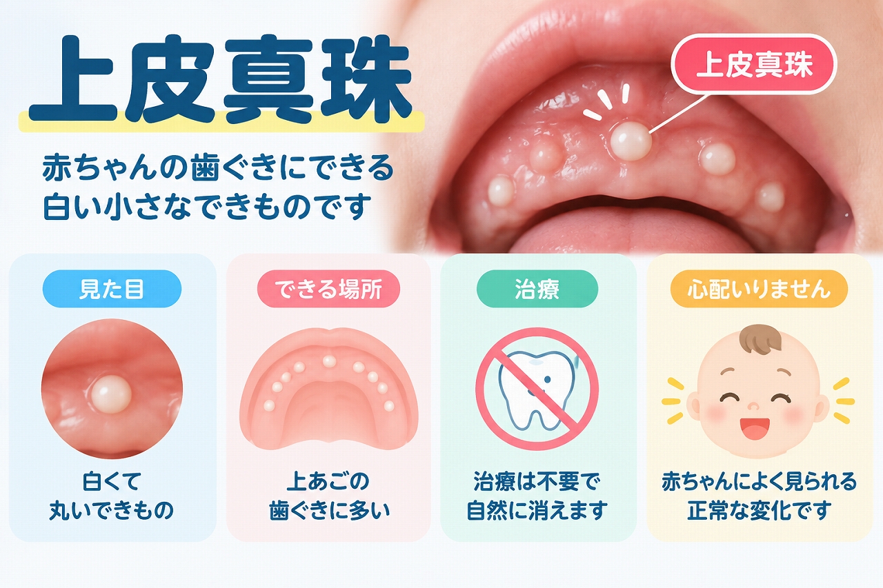 上皮真珠によって赤ちゃんの歯ぐきに白く丸い小さなできものがみられる状態と、自然に消えることが多いことを示したイラスト