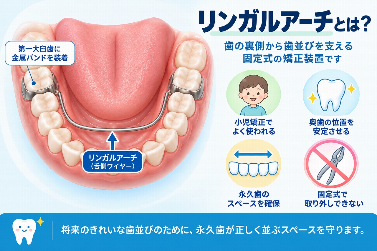リンガルアーチを下顎の第一大臼歯に固定し、歯の裏側を通るワイヤーで奥歯の位置や永久歯が生えるスペースを維持する仕組みを示した歯科イラスト