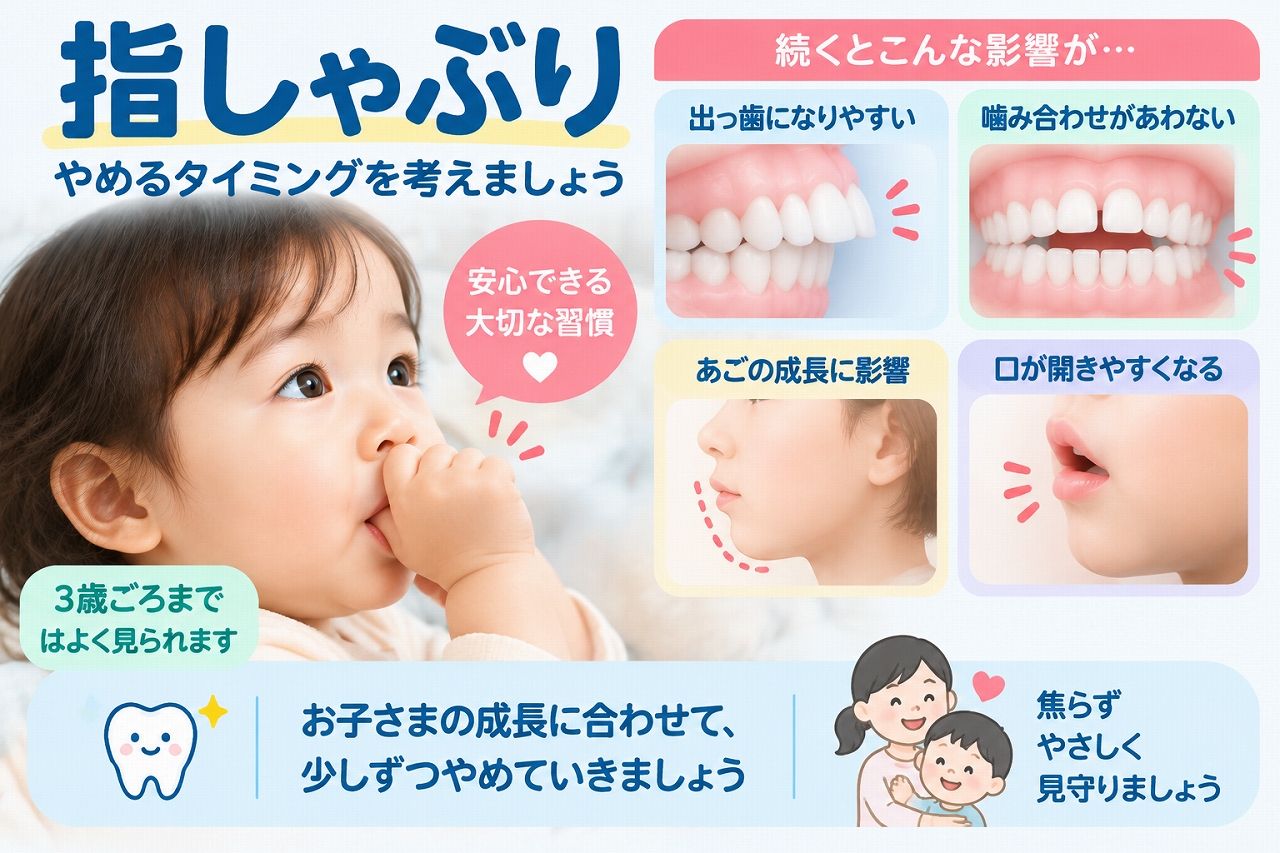 子どもの指しゃぶりが長く続いた場合に、出っ歯や開咬など歯並び・噛み合わせに影響することを示した歯科イラスト