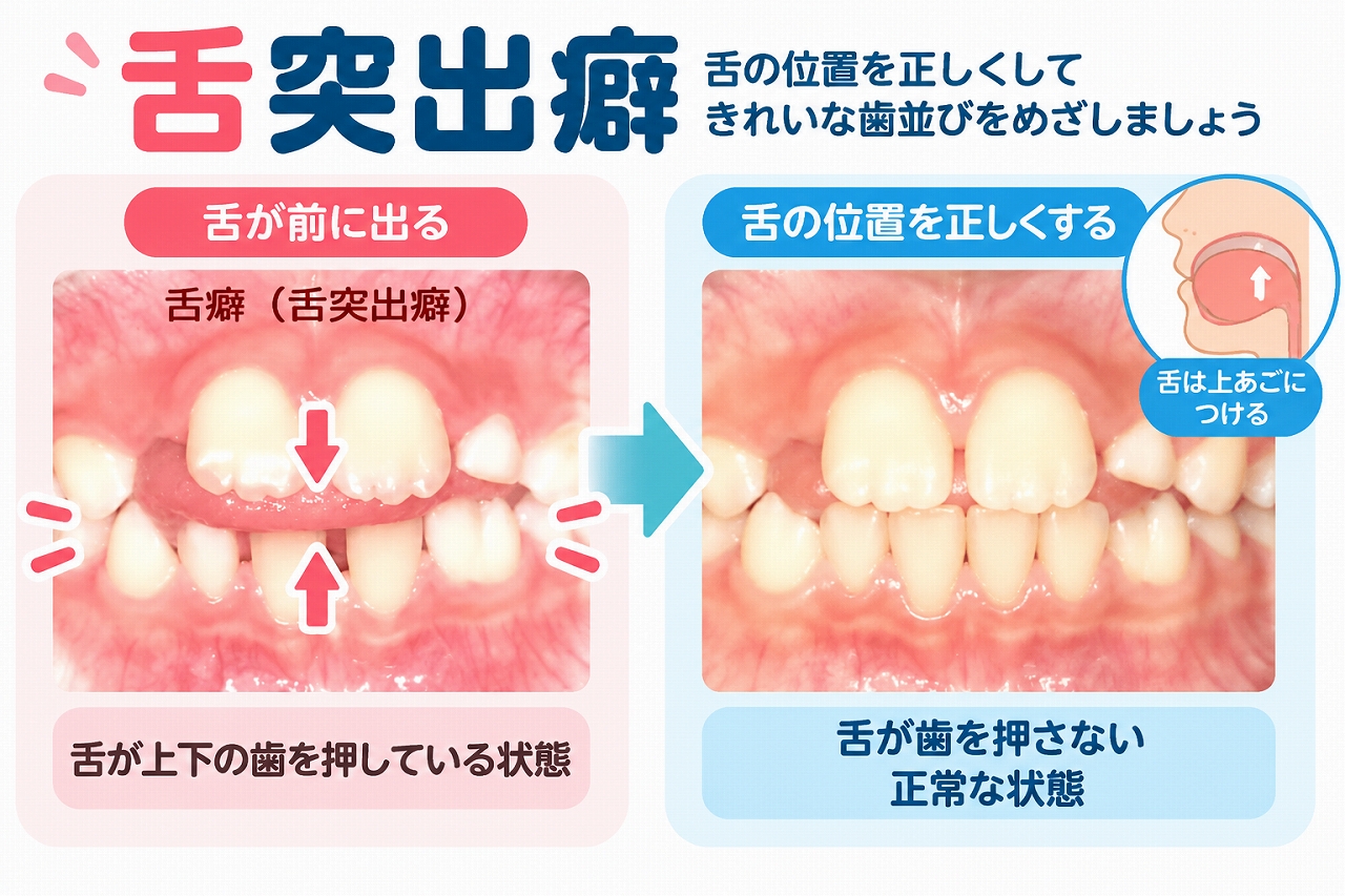 舌突出癖で舌が上下の前歯の間に入り歯を押している状態と、舌を正しい位置に改善した状態を比較した歯科イラスト