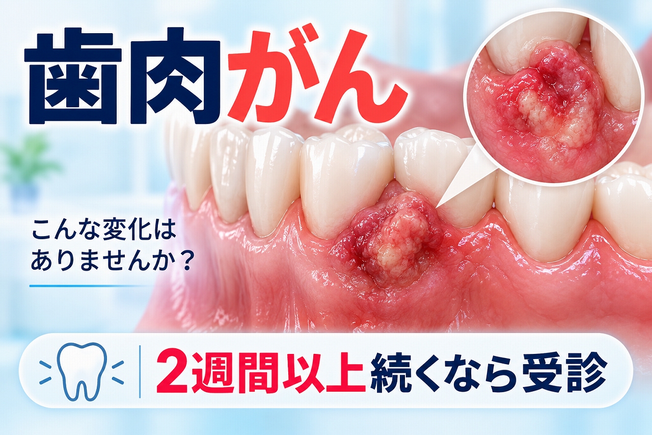 歯ぐきにできた治りにくい腫れや病変と、歯肉がんを疑う症状の受診目安を示したイラスト