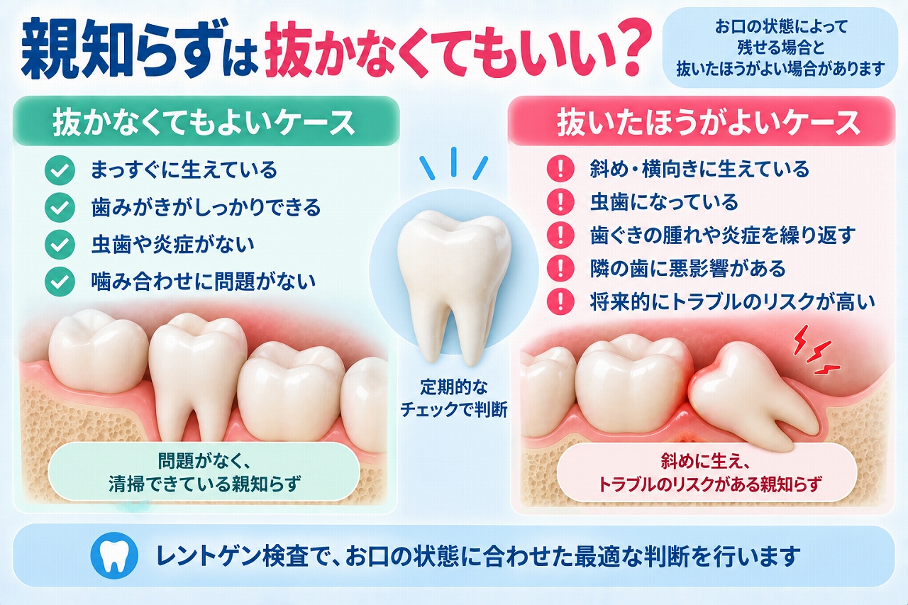 親知らずについて、まっすぐ生えて清掃できるなど抜かなくてもよいケースと、斜め・横向きや虫歯、炎症など抜歯を検討するケースを比較した図