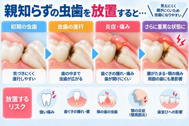 親知らずの虫歯を放置すると？｜痛み・腫れ・隣の歯への影響