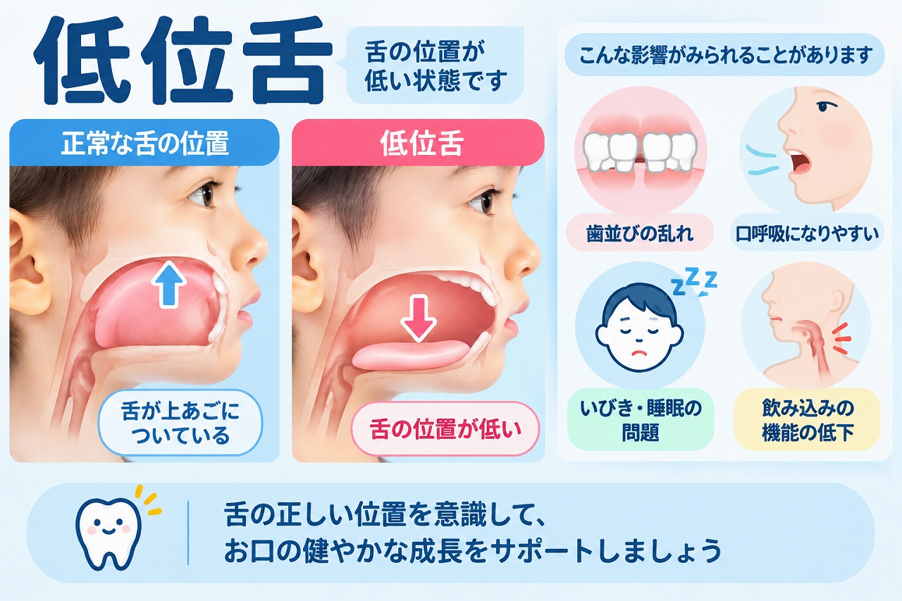 低位舌と正常な舌の位置を比較し、歯並びの乱れや口呼吸などへの影響を示した歯科イラスト