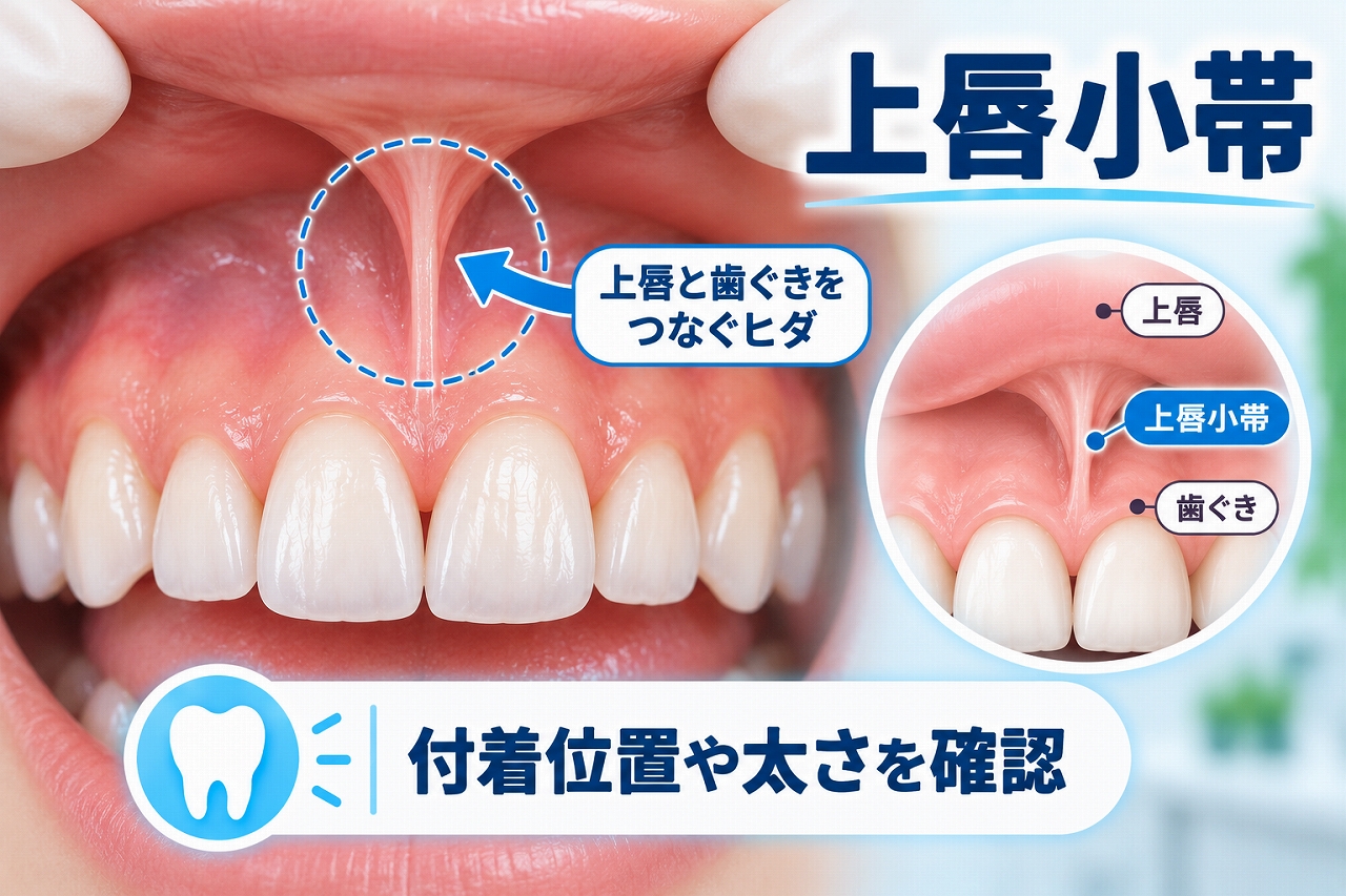 上唇の内側と上顎前歯中央の歯ぐきをつなぐ上唇小帯の位置と形を示したイラスト