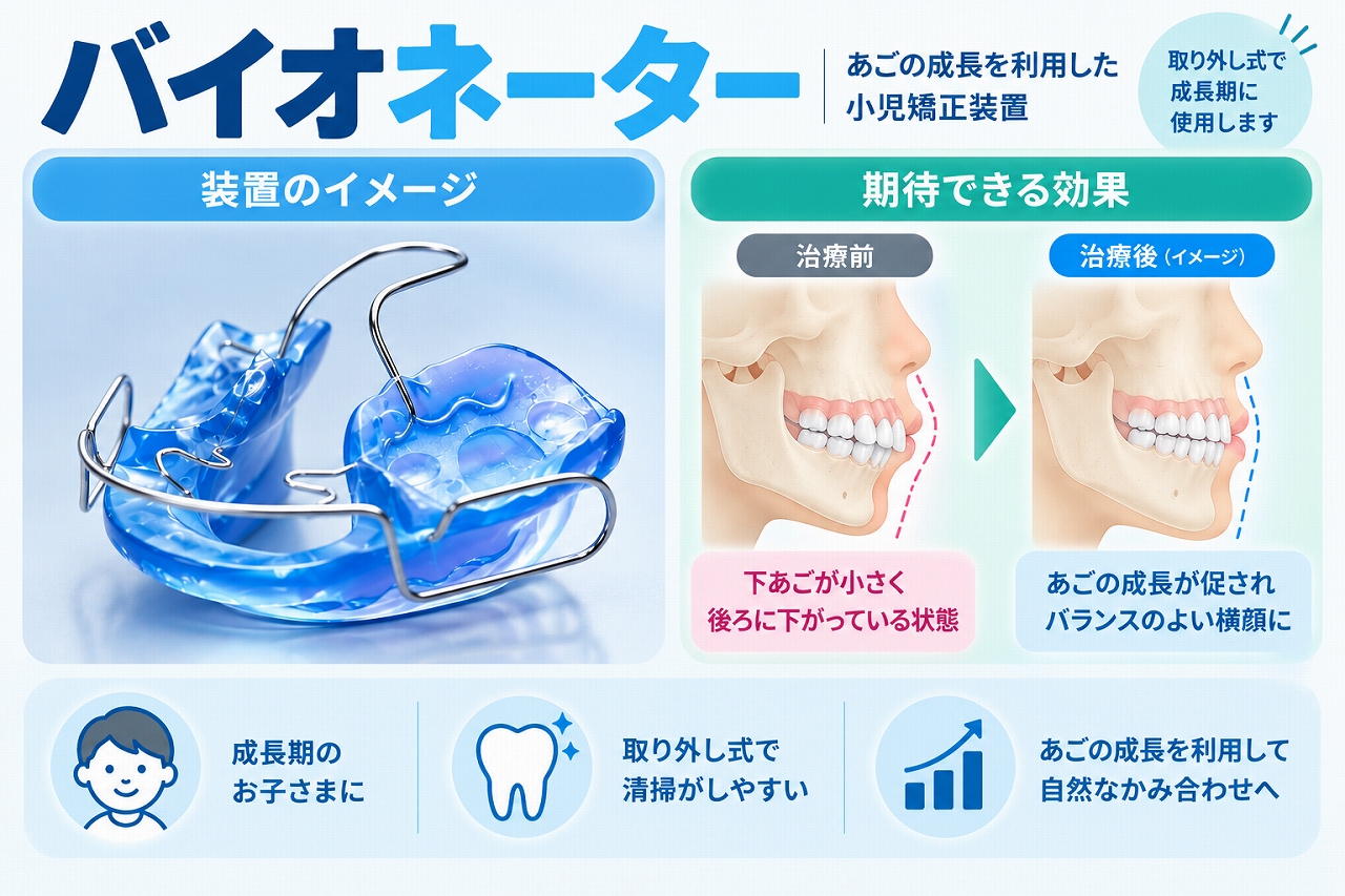 バイオネーターの装置と、成長期の顎の成長を利用して下顎の位置やかみ合わせの改善を図る小児矯正を示した歯科イラスト
