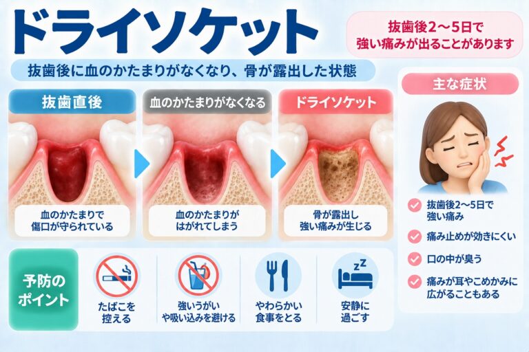 ドライソケットとは｜抜歯後に強い痛みが続く原因と対処法