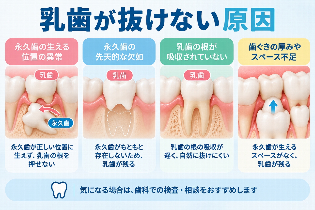 乳歯が抜けない原因として、永久歯の位置異常・永久歯の先天欠如・乳歯の歯根吸収の遅れなどを示した歯科イラスト