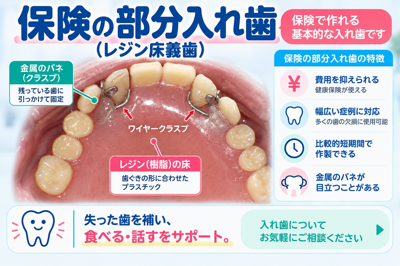 保険の部分入れ歯（レジン床義歯）について、歯ぐきに合わせたレジン床と残っている歯に固定する金属製クラスプの構造や特徴を示した歯科画像