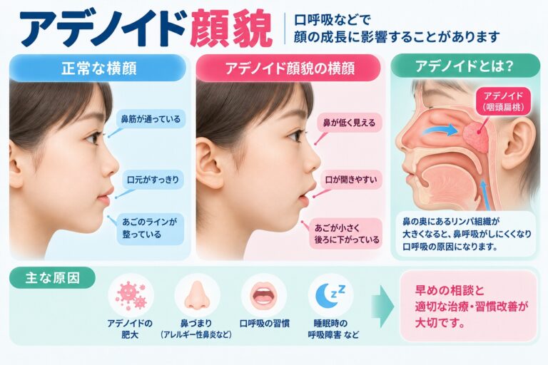 アデノイド顔貌とは？口呼吸と子どもの顔・顎の成長との関係