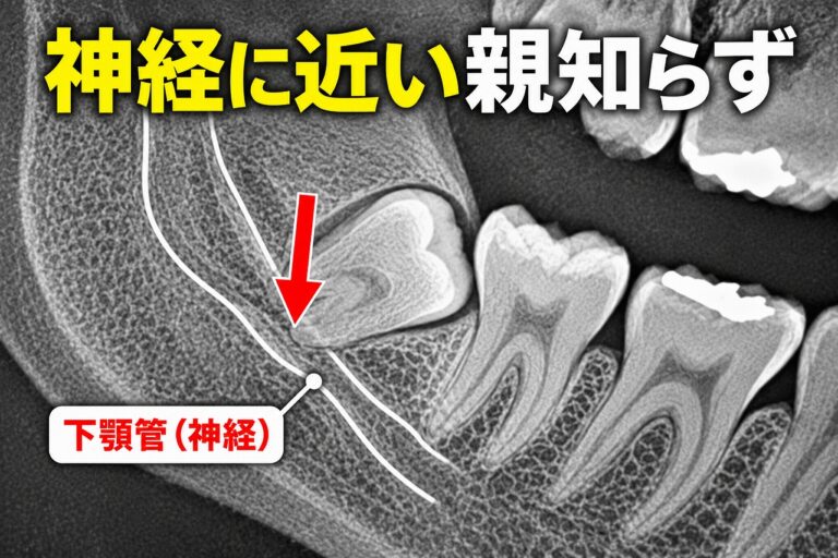神経に近い親知らず｜下顎管と接する親知らずの抜歯