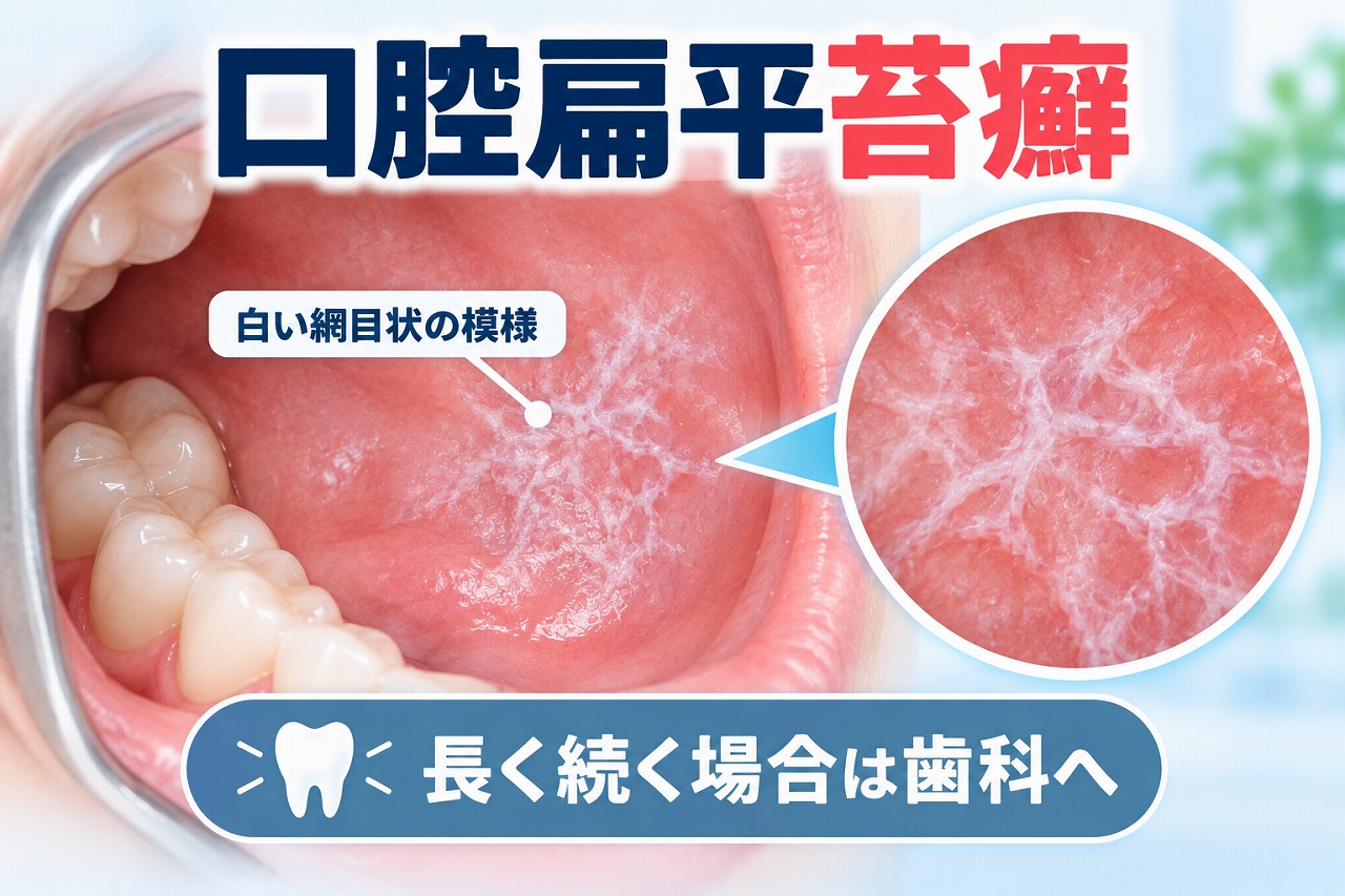 口腔扁平苔癬に特徴的な頬粘膜の白いレース状・網目状の病変を示したイラスト