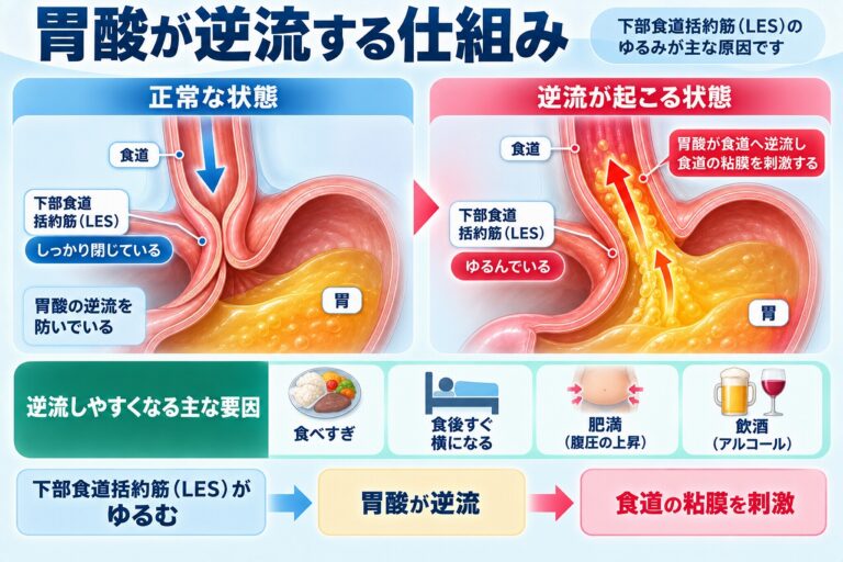 胃酸が逆流する仕組みを正常な状態と比較し、下部食道括約筋（LES）がゆるむことで胃酸が食道へ逆流して粘膜を刺激する流れを示した図