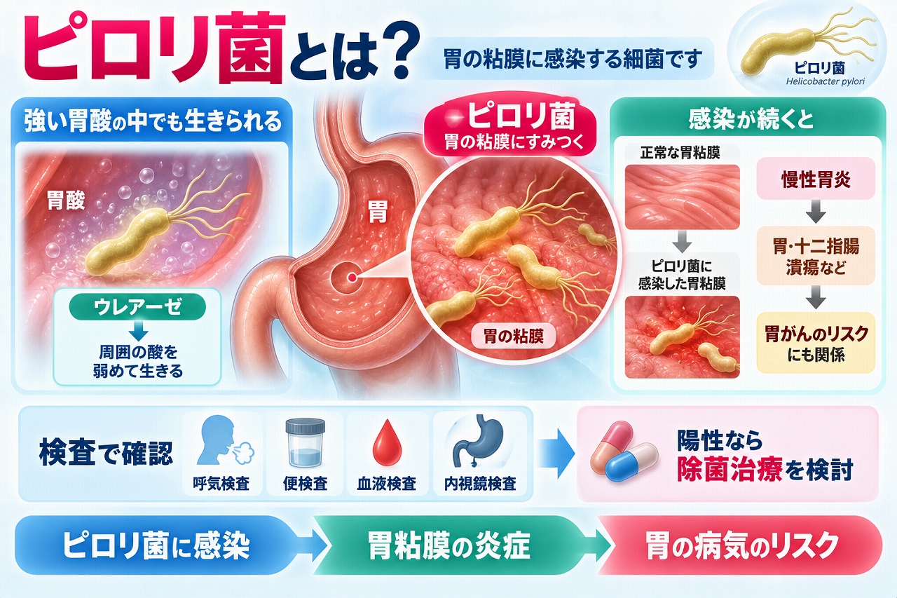 ピロリ菌が胃の粘膜に感染して慢性的な炎症を起こす仕組みと、慢性胃炎・胃十二指腸潰瘍・胃がんリスクとの関係、検査や除菌治療を示した図