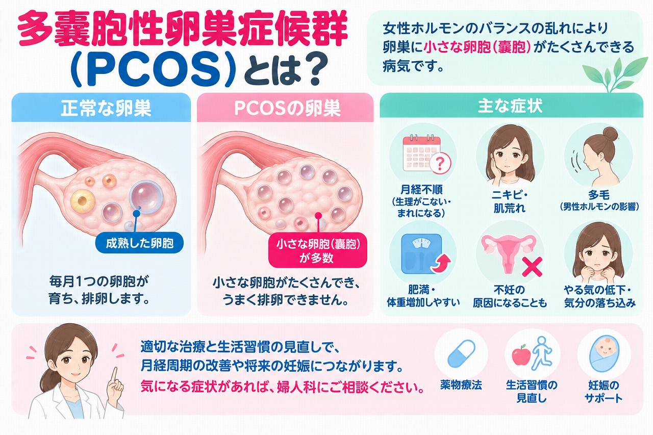 多嚢胞性卵巣症候群（PCOS）の特徴や症状を解説したインフォグラフィック。正常な卵巣とPCOSの卵巣を比較し、排卵障害や月経不順、ニキビ、多毛、体重増加、不妊などの主な症状と治療・生活習慣改善について紹介