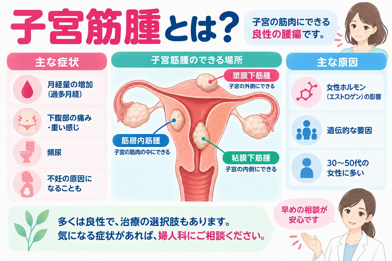 子宮筋腫の種類や症状を解説したインフォグラフィック。子宮の筋肉にできる良性腫瘍について、漿膜下筋腫・筋層内筋腫・粘膜下筋腫のできる場所と、過多月経、下腹部の痛みや圧迫感、頻尿、不妊などの主な症状を紹介