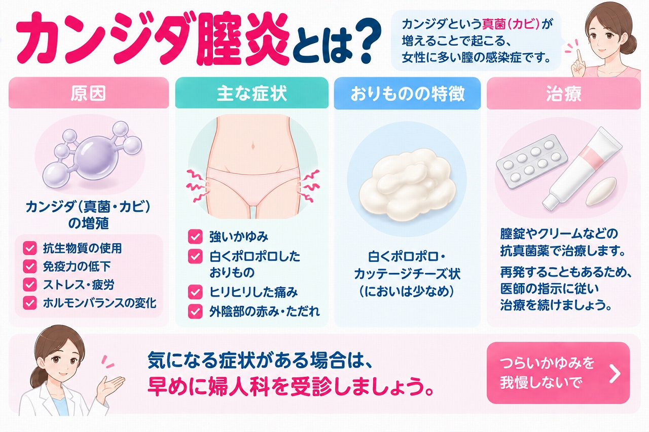 カンジダ膣炎の原因や症状を解説したインフォグラフィック。カンジダという真菌が増殖することで起こり、強いかゆみ、ヒリヒリした痛み、外陰部の赤み、白くポロポロしたカッテージチーズ状のおりものなどが現れることや、抗真菌薬による治療を紹介