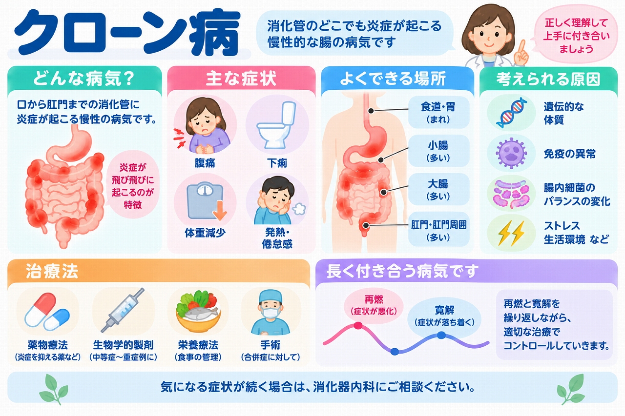 クローン病の症状や炎症が起こる場所、原因、治療法を解説した医療インフォグラフィック。腹痛、下痢、体重減少、発熱などの症状と、小腸・大腸・肛門周囲などに炎症が起こる特徴を紹介。遺伝的要因、免疫の異常、腸内細菌との関係や、薬物療法、生物学的製剤、栄養療法、手術などの治療法を図解。