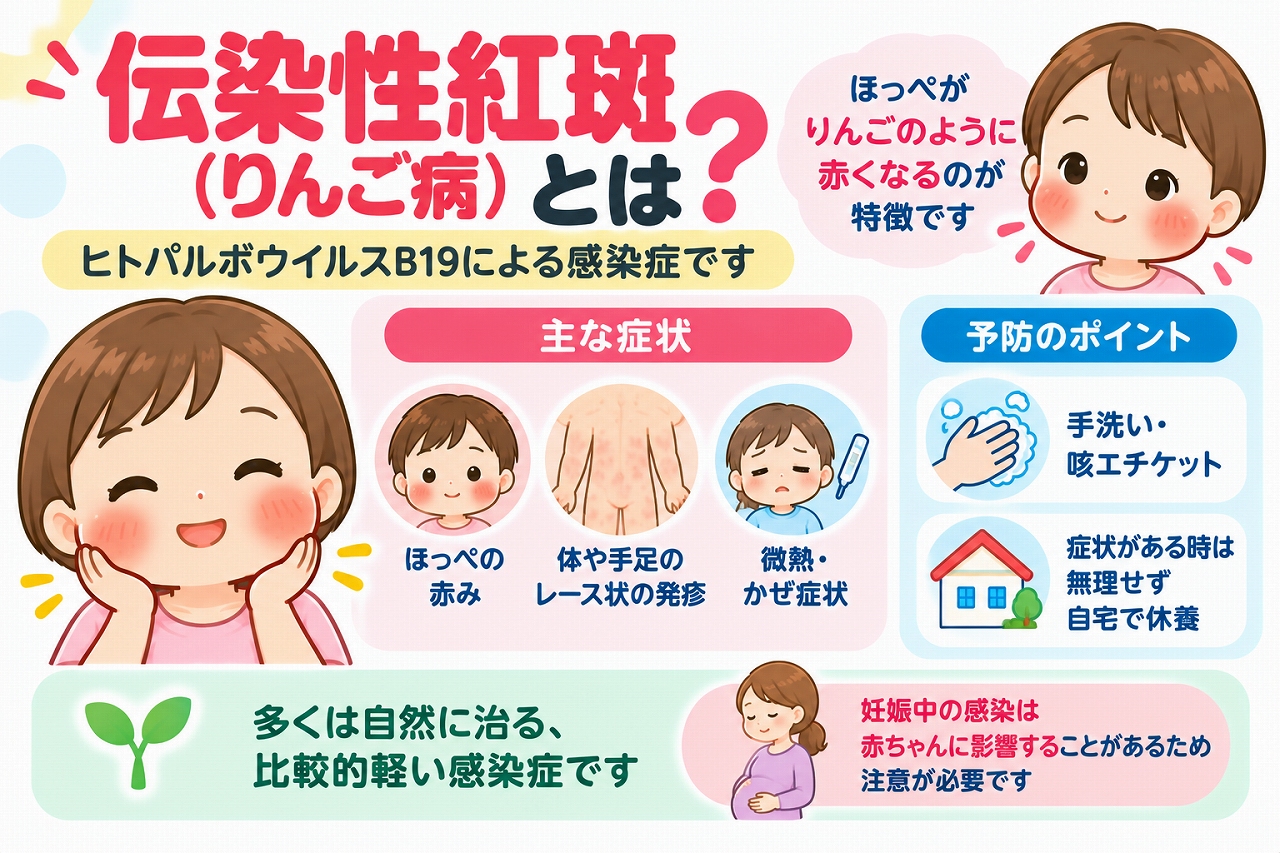 伝染性紅斑（りんご病）の原因や主な症状、予防方法を解説した医療インフォグラフィック。ヒトパルボウイルスB19による感染と、りんごのように赤くなる両頬、体や手足に現れるレース状の発疹、微熱や風邪に似た症状をイラストで紹介。手洗いや咳エチケットによる感染対策と、妊娠中の感染による胎児への影響について図解。
