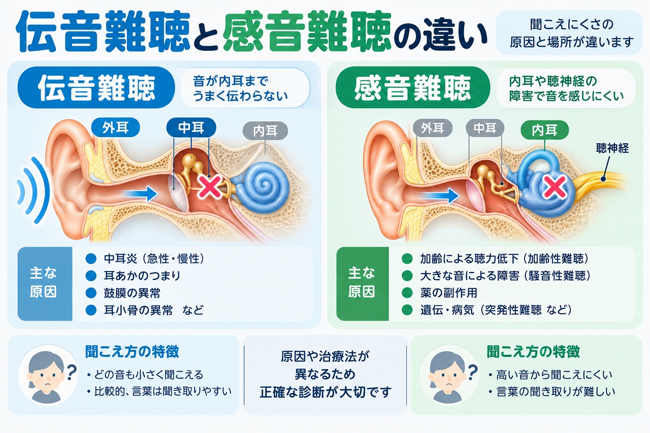 伝音難聴と感音難聴の違いを比較したインフォグラフィック。外耳・中耳で音の伝わりが妨げられる伝音難聴と、内耳や聴神経の障害で起こる感音難聴について、原因や聞こえ方の特徴を紹介