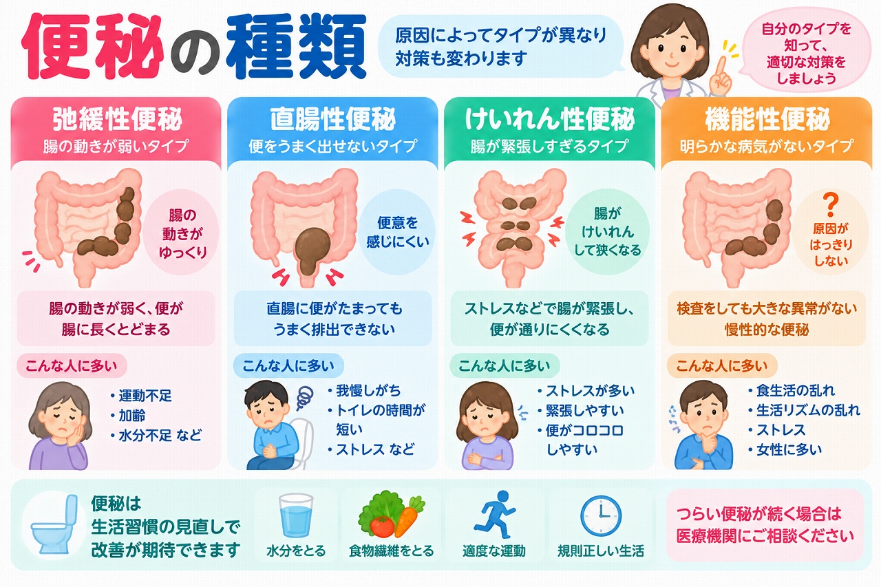 便秘の種類と特徴を比較した医療インフォグラフィック。弛緩性便秘、直腸性便秘、けいれん性便秘、機能性便秘をイラストで紹介。腸の動きの低下、排便困難、ストレスによる腸の変化などの特徴と、水分補給、食物繊維、適度な運動、規則正しい生活などの対処法を図解。
