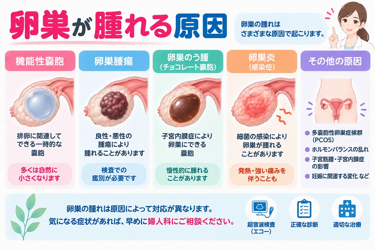 卵巣が腫れる主な原因を解説したインフォグラフィック。排卵に関連する機能性嚢胞、卵巣腫瘍、子宮内膜症によるチョコレート嚢胞、感染による炎症、多嚢胞性卵巣症候群など、卵巣の腫れにつながる原因を紹介