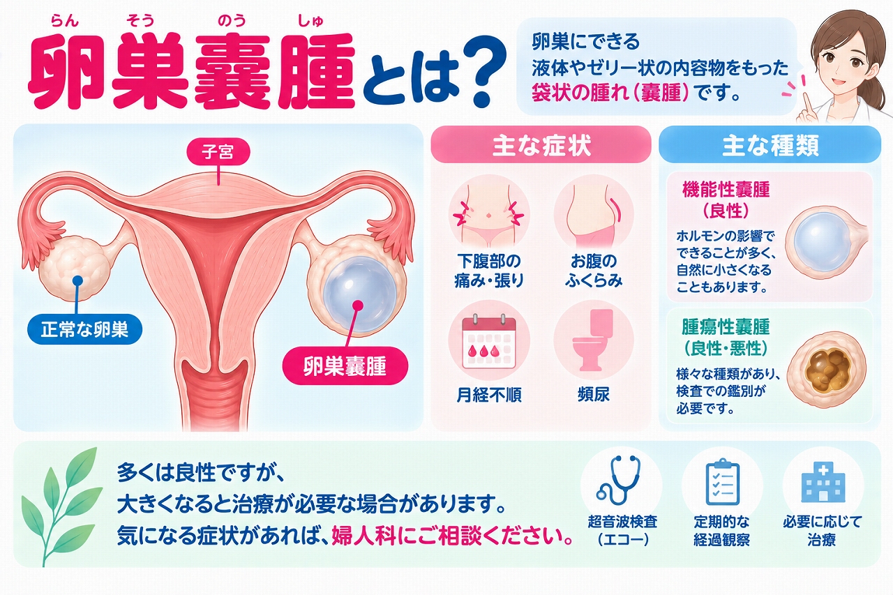卵巣嚢腫の特徴や症状、種類を解説したインフォグラフィック。正常な卵巣と嚢腫ができた卵巣を比較し、下腹部の痛みや張り、お腹のふくらみ、月経不順、頻尿などの症状と、機能性嚢胞や腫瘍性嚢腫について紹介