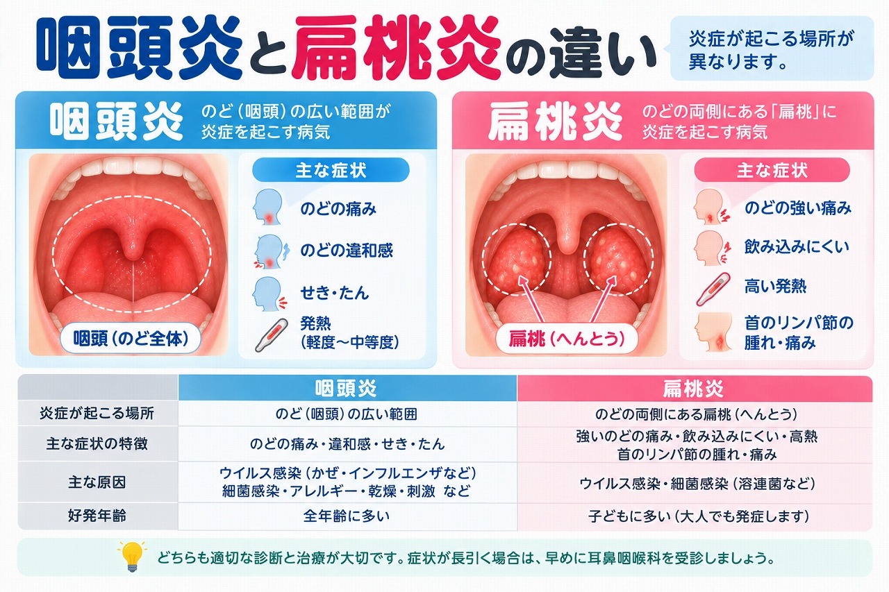 咽頭炎と扁桃炎の違いを比較したインフォグラフィック。のどの広い範囲に炎症が起こる咽頭炎と、のどの両側にある扁桃に炎症が起こる扁桃炎について、炎症部位、のどの痛み、発熱、飲み込みにくさ、原因などの違いを紹介
