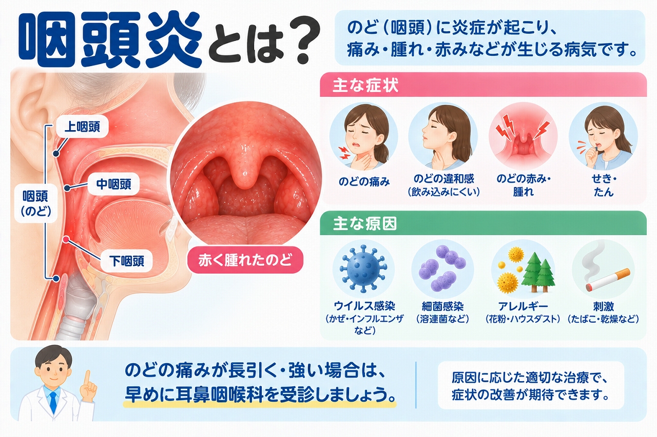 咽頭炎の原因や症状を解説したインフォグラフィック。咽頭に炎症が起こり、のどの痛み、腫れ・赤み、飲み込みにくさ、せき・たんなどの症状が現れることや、ウイルス・細菌感染、アレルギー、乾燥やたばこなどの刺激との関係を紹介