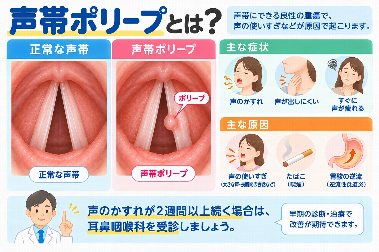 声帯ポリープの原因や症状を解説したインフォグラフィック。正常な声帯とポリープができた声帯を比較し、声のかすれ、声が出しにくい、声が疲れやすいなどの症状と、声の使いすぎ、喫煙、胃酸の逆流などの主な原因を紹介