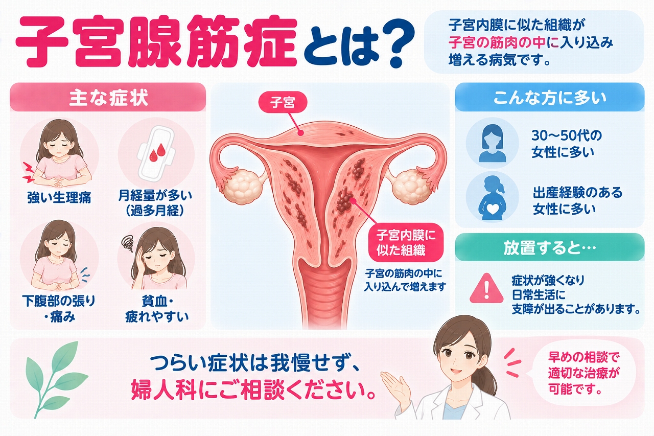 子宮腺筋症の特徴や症状を解説したインフォグラフィック。子宮内膜に似た組織が子宮の筋肉の中に入り込んで増殖し、強い生理痛、過多月経、下腹部の痛みや張り、貧血などを引き起こすことを紹介