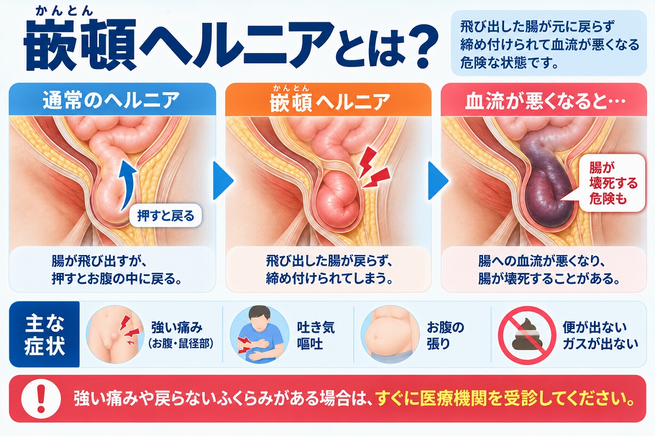 嵌頓ヘルニアとは、飛び出した腸などが元に戻らなくなった状態で、締め付けによって血流が悪くなると腸管壊死につながる危険があることや、強い痛み・吐き気・腹部膨満などの症状を示した図