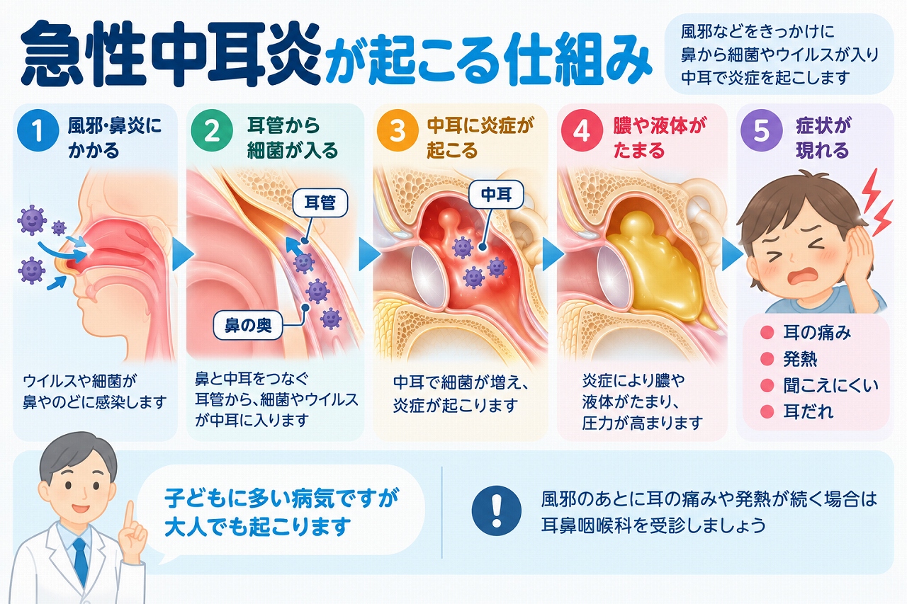 急性中耳炎が起こる仕組みを解説したインフォグラフィック。風邪や鼻炎をきっかけに細菌やウイルスが耳管を通って中耳へ入り、炎症や膿・液体の貯留が起こり、耳の痛み、発熱、聞こえにくさ、耳だれなどの症状が現れる流れを紹介